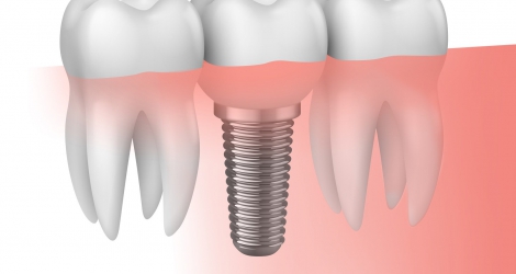 La duración de los implantes dentales