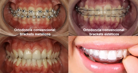 Los beneficios de la Ortodoncia
